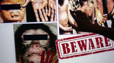 EUA confirma primer caso de viruela de los monos