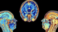 Covid-19 producen cambios en el cerebro